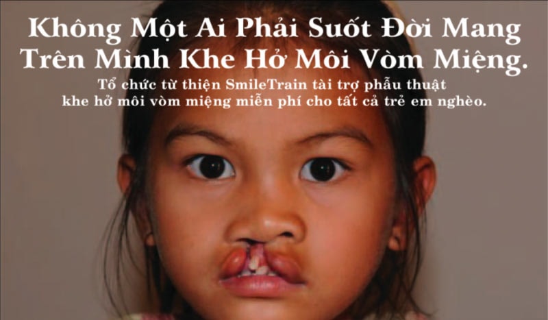 SmileTrain phẫu thuật khe hở môi, vòm miệng miễn phí   