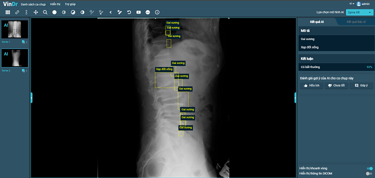 VinBigdata phát triển thành công tính năng chẩn đoán X-quang cột sống