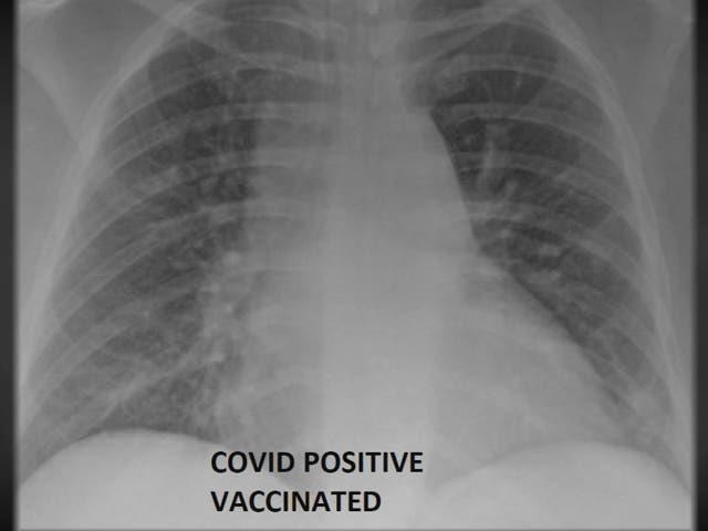 Hai phim X-rays phổi cho thấy sự khác biệt giữa người đã tiêm chủng và không tiêm chủng