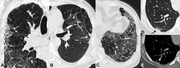 Những di chứng sau viêm phổi do SARS-CoV-2 được ghi nhận trên phim CT scan ngực sau 6 tháng theo dõi. A-dãn phế quản co kéo (mũi tên). B- xẹp phổi dạng đường (mũi tên). C- xơ phổi dạng tổ ong. D và E- dày màng phổi tạng (mũi tên)