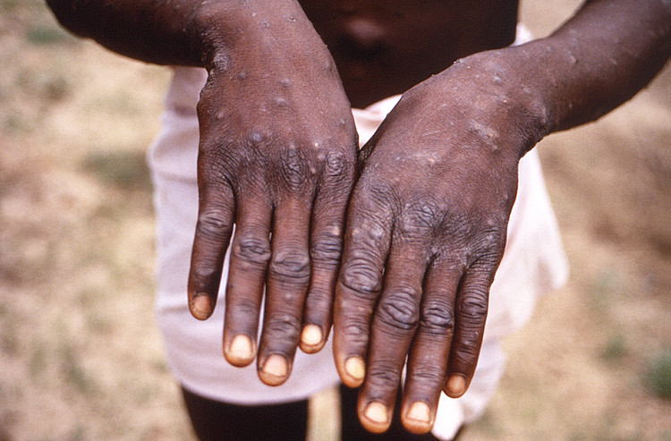 Đặc trưng của người mắc bệnh đậu mùa khỉ là các vết phát ban mưng mủ ở tay hoặc bất kỳ bộ phận nào trên cơ thể. Ảnh: Reuters.