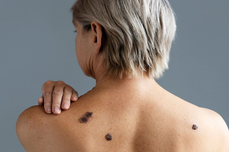 Nam giới có nguy cơ tử vong khi mắc ung thư da cao hơn nữ