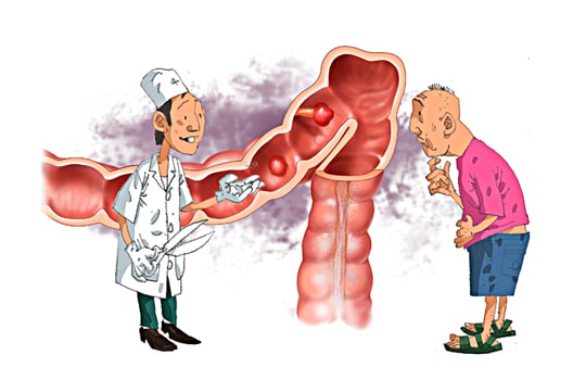 Bạn biết gì về ung thư đại trực tràng?