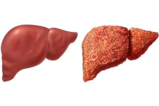 Tin vui cho bệnh nhân viêm gan siêu vi C