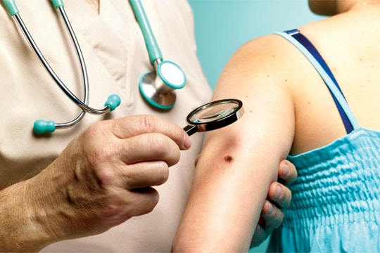 Nỗi lo bệnh ung thư da