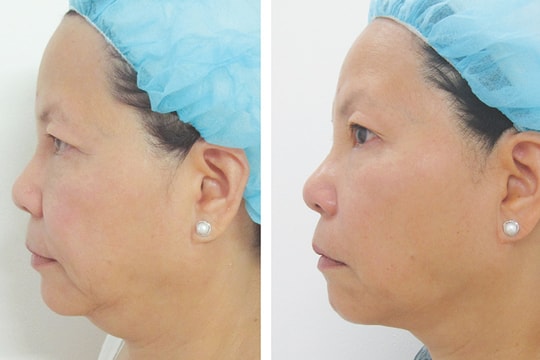 Trẻ hóa da bằng Thermage