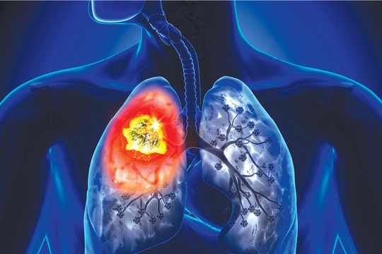 90% bệnh nhân ung thư phổi do hút thuốc lá