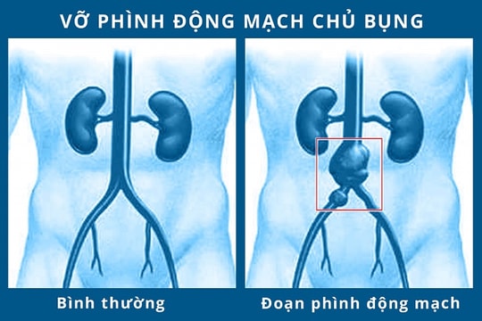 Vỡ phình động mạch chủ chậu chung – nguy cơ tử vong lên đến hơn 90%