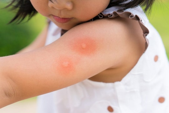 Tránh nhầm lẫn sốt xuất huyết với Covid-19