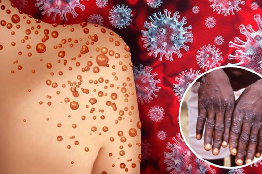 WHO chưa khuyến nghị tiêm vaccine đại trà cho bệnh đậu mùa khỉ