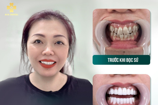Vì sao răng sứ Orodent tại AVA Dental được nhiều doanh nhân lựa chọn?