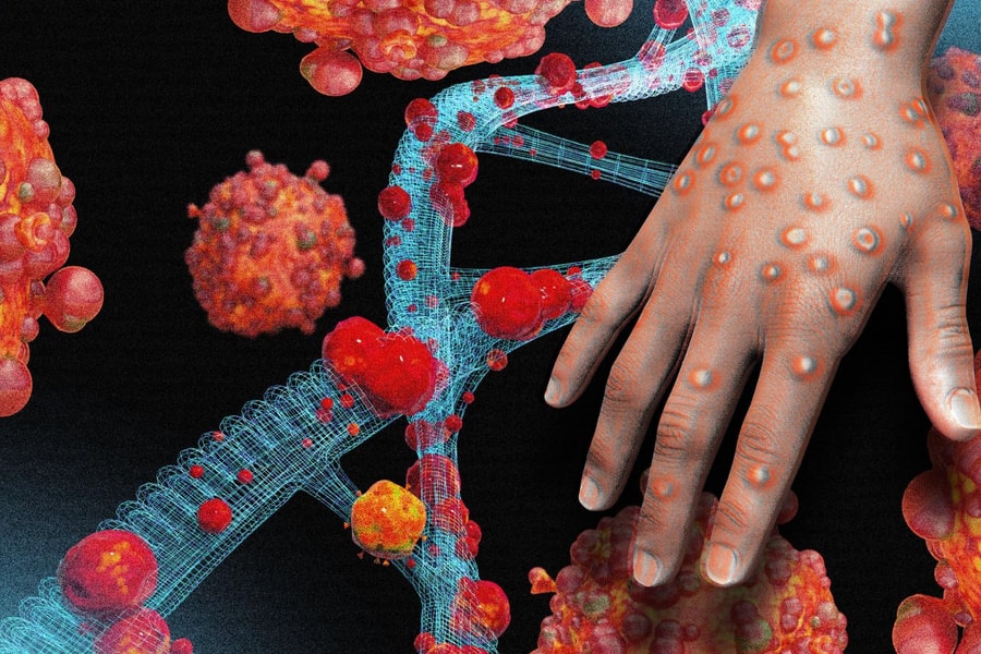 Bệnh đậu mùa khỉ: Những triệu chứng và biện pháp phòng ngừa